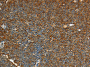 The image on the left is immunohistochemistry of paraffin-embedded Human lymphoma tissue using CSB-PA116506(ADM Antibody) at dilution 1/20, on the right is treated with synthetic peptide. (Original magnification: ×200)