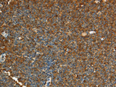 The image on the left is immunohistochemistry of paraffin-embedded Human lymphoma tissue using CSB-PA116506(ADM Antibody) at dilution 1/20, on the right is treated with synthetic peptide. (Original magnification: ×200)
