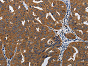 The image on the left is immunohistochemistry of paraffin-embedded Human ovarian cancer tissue using CSB-PA116985(PDCD2 Antibody) at dilution 1/10, on the right is treated with synthetic peptide. (Original magnification: ×200)