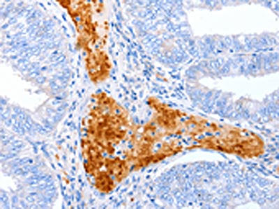 The image on the left is immunohistochemistry of paraffin-embedded Human cervical cancer tissue using CSB-PA117174(ENPP7 Antibody) at dilution 1/50, on the right is treated with synthetic peptide. (Original magnification: ×200)