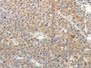 The image on the left is immunohistochemistry of paraffin-embedded Human liver cancer tissue using CSB-PA117413(SV2A Antibody) at dilution 1/25, on the right is treated with synthetic peptide. (Original magnification: ×200)