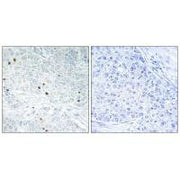 Immunohistochemistry analysis of paraffin-embedded human breast carcinoma tissue, using TP53INP2 antibody.