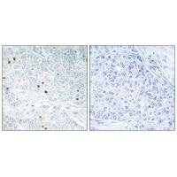 Immunohistochemistry analysis of paraffin-embedded human breast carcinoma tissue, using TP53INP2 antibody.