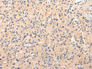 The image on the left is immunohistochemistry of paraffin-embedded Human liver cancer tissue using CSB-PA117475(CLU Antibody) at dilution 1/20, on the right is treated with synthetic peptide. (Original magnification: ×200)