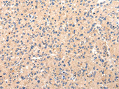 The image on the left is immunohistochemistry of paraffin-embedded Human liver cancer tissue using CSB-PA117475(CLU Antibody) at dilution 1/20, on the right is treated with synthetic peptide. (Original magnification: ×200)