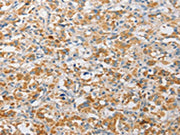 The image on the left is immunohistochemistry of paraffin-embedded Human thyroid cancer tissue using CSB-PA117483(APOBEC3G Antibody) at dilution 1/30, on the right is treated with fusion protein. (Original magnification: ×200)
