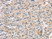 The image on the left is immunohistochemistry of paraffin-embedded Human liver cancer tissue using CSB-PA117539(LZTS1 Antibody) at dilution 1/20, on the right is treated with synthetic peptide. (Original magnification: ×200)