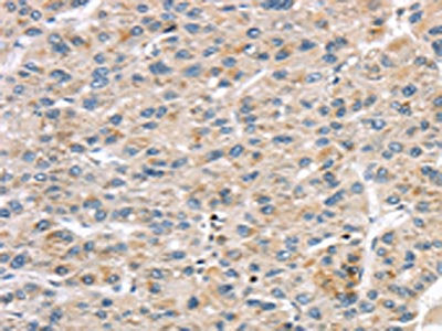 The image on the left is immunohistochemistry of paraffin-embedded Human liver cancer tissue using CSB-PA117539(LZTS1 Antibody) at dilution 1/20, on the right is treated with synthetic peptide. (Original magnification: ×200)