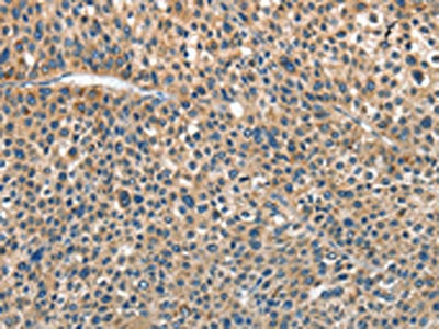 The image on the left is immunohistochemistry of paraffin-embedded Human liver cancer tissue using CSB-PA117703(ANGPT1 Antibody) at dilution 1/30, on the right is treated with fusion protein. (Original magnification: ×200)