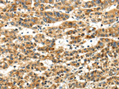 The image on the left is immunohistochemistry of paraffin-embedded Human ovarian cancer tissue using CSB-PA117894(PAPPA Antibody) at dilution 1/50, on the right is treated with synthetic peptide. (Original magnification: ×200)