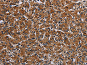 The image on the left is immunohistochemistry of paraffin-embedded Human prostate cancer tissue using CSB-PA117915(IRGM Antibody) at dilution 1/50, on the right is treated with fusion protein. (Original magnification: ×200)