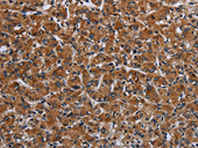 The image on the left is immunohistochemistry of paraffin-embedded Human prostate cancer tissue using CSB-PA117915(IRGM Antibody) at dilution 1/50, on the right is treated with fusion protein. (Original magnification: ×200)