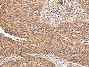 The image on the left is immunohistochemistry of paraffin-embedded Human lung cancer tissue using CSB-PA117927(ZNF146 Antibody) at dilution 1/20, on the right is treated with synthetic peptide. (Original magnification: ×200)