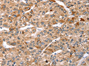 The image on the left is immunohistochemistry of paraffin-embedded Human liver cancer tissue using CSB-PA118057(TBC1D1 Antibody) at dilution 1/35, on the right is treated with synthetic peptide. (Original magnification: ×200)