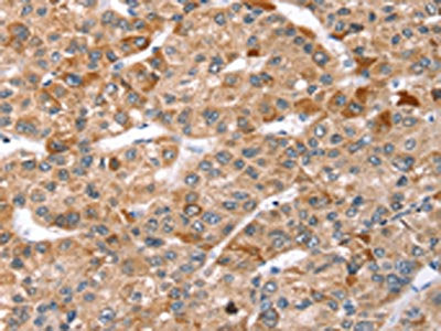 The image on the left is immunohistochemistry of paraffin-embedded Human liver cancer tissue using CSB-PA118057(TBC1D1 Antibody) at dilution 1/35, on the right is treated with synthetic peptide. (Original magnification: ×200)