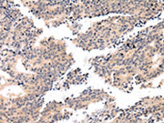 The image on the left is immunohistochemistry of paraffin-embedded Human prostate cancer tissue using CSB-PA118113(VSIG8 Antibody) at dilution 1/20, on the right is treated with fusion protein. (Original magnification: ×200)
