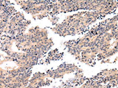 The image on the left is immunohistochemistry of paraffin-embedded Human prostate cancer tissue using CSB-PA118113(VSIG8 Antibody) at dilution 1/20, on the right is treated with fusion protein. (Original magnification: ×200)