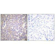 Immunohistochemical analysis of paraffin-embedded human breast carcinoma tissue using Claudin 2 antibody.