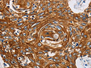 The image on the left is immunohistochemistry of paraffin-embedded Human esophagus cancer tissue using CSB-PA118272(GRIN1 Antibody) at dilution 1/45, on the right is treated with synthetic peptide. (Original magnification: ×200)