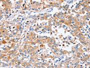 The image on the left is immunohistochemistry of paraffin-embedded Human liver cancer tissue using CSB-PA118443(PPOX Antibody) at dilution 1/40, on the right is treated with synthetic peptide. (Original magnification: ×200)