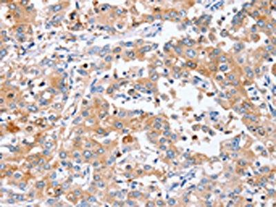 The image on the left is immunohistochemistry of paraffin-embedded Human liver cancer tissue using CSB-PA118443(PPOX Antibody) at dilution 1/40, on the right is treated with synthetic peptide. (Original magnification: ×200)