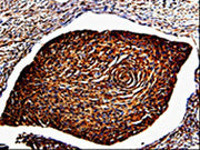 The image is immunohistochemistry of paraffin-embedded Human cervical cancer tissue using CSB-PA118689(ANXA7 Antibody) at dilution 1/150. (Original magnification: ×200)