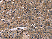 The image on the left is immunohistochemistry of paraffin-embedded Human liver cancer tissue using CSB-PA118886(FAM107A Antibody) at dilution 1/30, on the right is treated with fusion protein. (Original magnification: ×200)