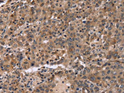 The image on the left is immunohistochemistry of paraffin-embedded Human liver cancer tissue using CSB-PA118886(FAM107A Antibody) at dilution 1/30, on the right is treated with fusion protein. (Original magnification: ×200)