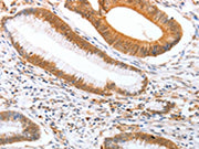 The image on the left is immunohistochemistry of paraffin-embedded Human colon cancer tissue using CSB-PA118910(DPPA2 Antibody) at dilution 1/25, on the right is treated with fusion protein. (Original magnification: ×200)