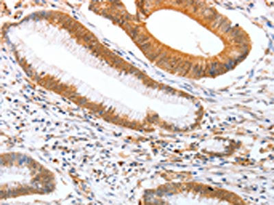 The image on the left is immunohistochemistry of paraffin-embedded Human colon cancer tissue using CSB-PA118910(DPPA2 Antibody) at dilution 1/25, on the right is treated with fusion protein. (Original magnification: ×200)