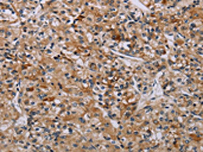 The image on the left is immunohistochemistry of paraffin-embedded Human prostate cancer tissue using CSB-PA119051(AATK Antibody) at dilution 1/45, on the right is treated with synthetic peptide. (Original magnification: ×200)