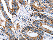 The image on the left is immunohistochemistry of paraffin-embedded Human colon cancer tissue using CSB-PA119092(CLDN7 Antibody) at dilution 1/50, on the right is treated with synthetic peptide. (Original magnification: ×200)