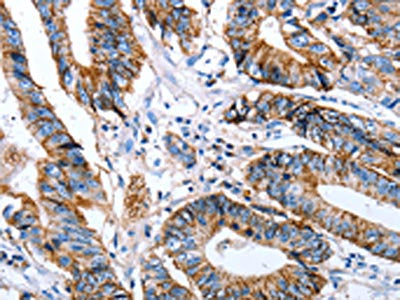 The image on the left is immunohistochemistry of paraffin-embedded Human colon cancer tissue using CSB-PA119092(CLDN7 Antibody) at dilution 1/50, on the right is treated with synthetic peptide. (Original magnification: ×200)