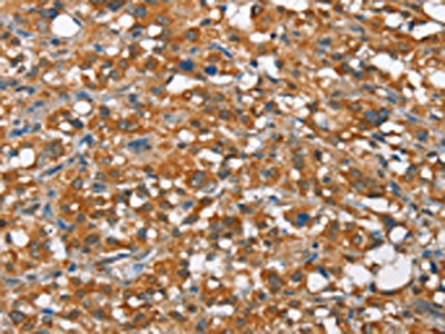The image on the left is immunohistochemistry of paraffin-embedded Human thyroid cancer tissue using CSB-PA119240(ARMCX2 Antibody) at dilution 1/30, on the right is treated with fusion protein. (Original magnification: ×200)
