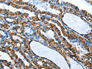 The image on the left is immunohistochemistry of paraffin-embedded Human thyroid cancer tissue using CSB-PA119248(TNNI3 Antibody) at dilution 1/20, on the right is treated with fusion protein. (Original magnification: ×200)