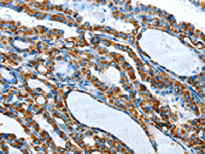 The image on the left is immunohistochemistry of paraffin-embedded Human thyroid cancer tissue using CSB-PA119248(TNNI3 Antibody) at dilution 1/20, on the right is treated with fusion protein. (Original magnification: ×200)