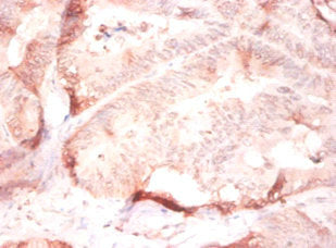 Immunohistochemistry of paraffin-embedded human colon cancer using CSB-PA11947A0Rb at dilution of 1:50