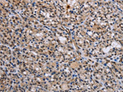 The image is immunohistochemistry of paraffin-embedded Human thyroid cancer tissue using CSB-PA119536(GADD45A Antibody) at dilution 1/30. (Original magnification: 200)