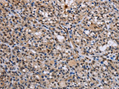 The image is immunohistochemistry of paraffin-embedded Human thyroid cancer tissue using CSB-PA119536(GADD45A Antibody) at dilution 1/30. (Original magnification: 200)