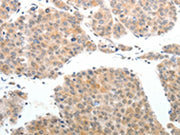 The image on the left is immunohistochemistry of paraffin-embedded Human liver cancer tissue using CSB-PA119696(ABL2 Antibody) at dilution 1/25, on the right is treated with synthetic peptide. (Original magnification: ×200)