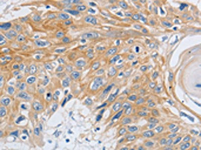 The image on the left is immunohistochemistry of paraffin-embedded Human esophagus cancer tissue using CSB-PA119717(SLC16A7 Antibody) at dilution 1/30, on the right is treated with synthetic peptide. (Original magnification: ×200)