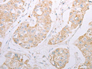The image on the left is immunohistochemistry of paraffin-embedded Human breast cancer tissue using CSB-PA119733(ADAM28 Antibody) at dilution 1/30, on the right is treated with synthetic peptide. (Original magnification: ×200)