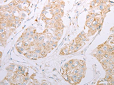 The image on the left is immunohistochemistry of paraffin-embedded Human breast cancer tissue using CSB-PA119733(ADAM28 Antibody) at dilution 1/30, on the right is treated with synthetic peptide. (Original magnification: ×200)