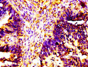 IHC image of CSB-PA11999A0Rb diluted at 1:100 and staining in paraffin-embedded human ovarian cancer performed on a Leica BondTM system. After dewaxing and hydration, antigen retrieval was mediated by high pressure in a citrate buffer (pH 6.0). Se...