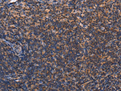 The image on the left is immunohistochemistry of paraffin-embedded Human tonsil tissue using CSB-PA120056(RDX Antibody) at dilution 1/60, on the right is treated with fusion protein. (Original magnification: ×200)