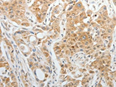 The image on the left is immunohistochemistry of paraffin-embedded Human lung cancer tissue using CSB-PA120090(TTF2 Antibody) at dilution 1/5, on the right is treated with synthetic peptide. (Original magnification: ×200)