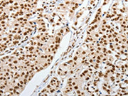 The image on the left is immunohistochemistry of paraffin-embedded Human breast cancer tissue using CSB-PA120136(PIWIL3 Antibody) at dilution 1/20, on the right is treated with synthetic peptide. (Original magnification: ×200)