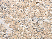 The image on the left is immunohistochemistry of paraffin-embedded Human esophagus cancer tissue using CSB-PA120313(TSPYL2 Antibody) at dilution 1/30, on the right is treated with synthetic peptide. (Original magnification: ×200)