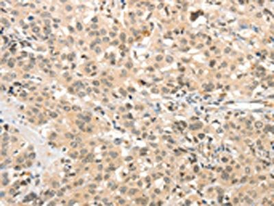The image on the left is immunohistochemistry of paraffin-embedded Human esophagus cancer tissue using CSB-PA120313(TSPYL2 Antibody) at dilution 1/30, on the right is treated with synthetic peptide. (Original magnification: ×200)