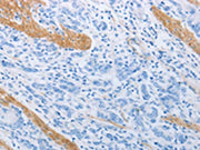 The image on the left is immunohistochemistry of paraffin-embedded Human gastic cancer tissue using CSB-PA120361(ADRB3 Antibody) at dilution 1/20, on the right is treated with synthetic peptide. (Original magnification: ×200)